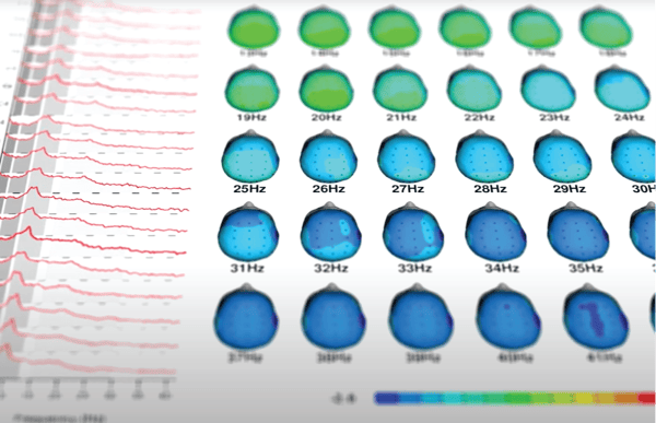 A print out of a QEEG lab report