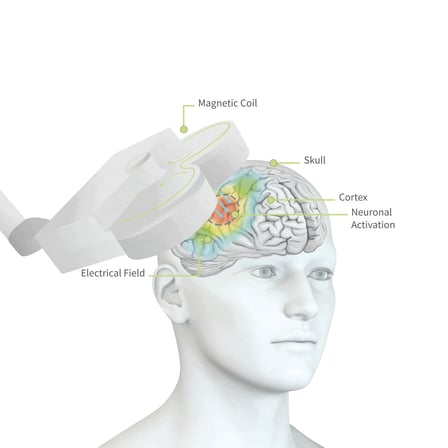 Researchers treat OCD with TMS, a therapy where a magnetic coil is placed on a specific region of the head to stimulate brain pathways