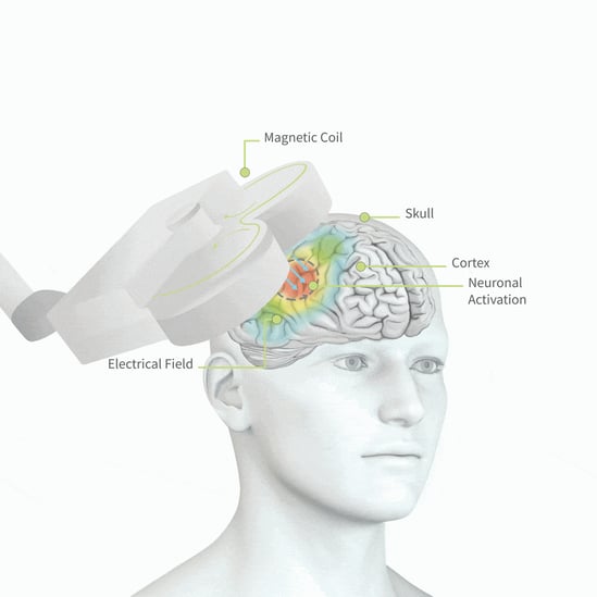 neurocare now offers Outpatient TMS in Melbourne