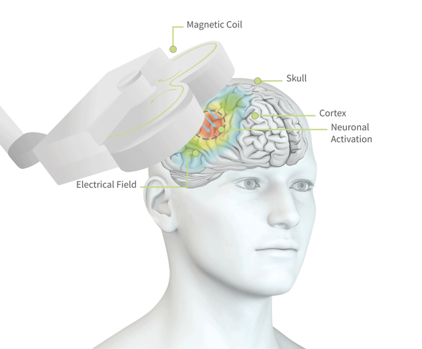 rTMS Diagram_brain pathways_coil placement