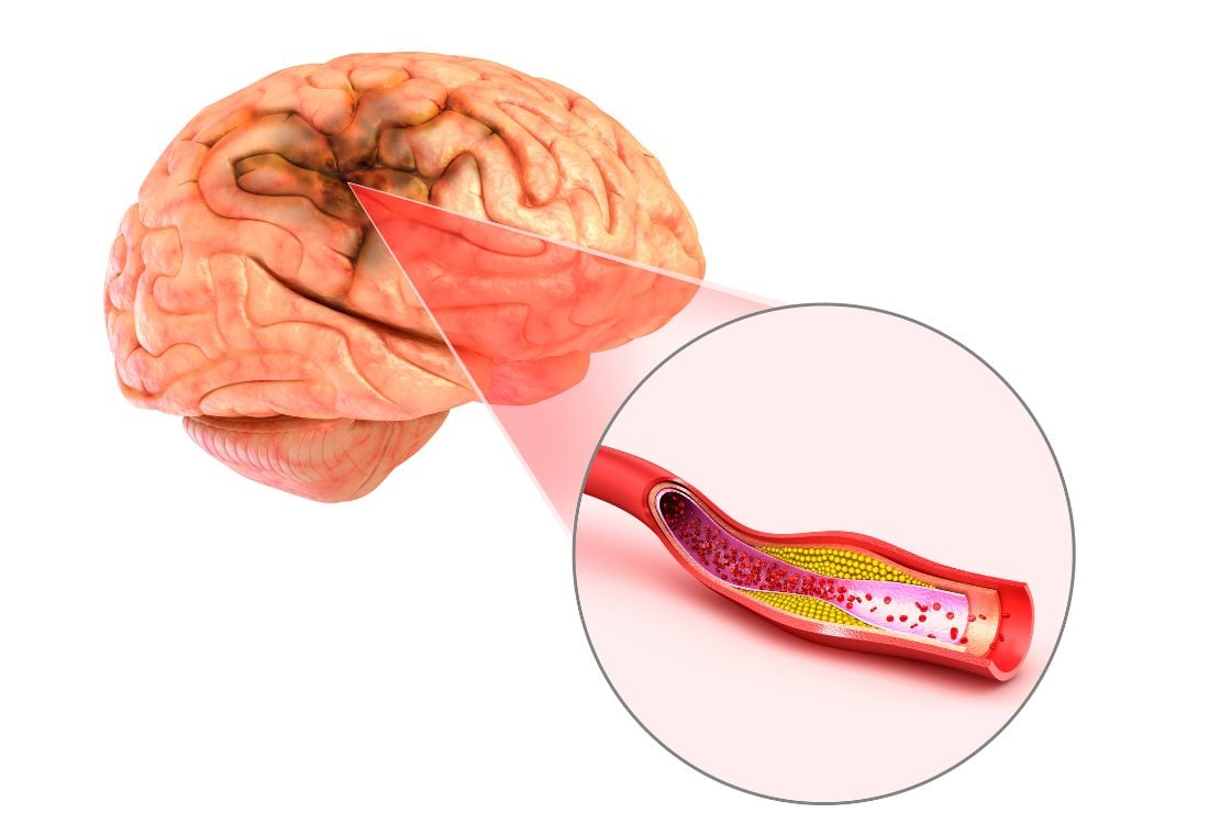 stroke-vessel-in-the-brain